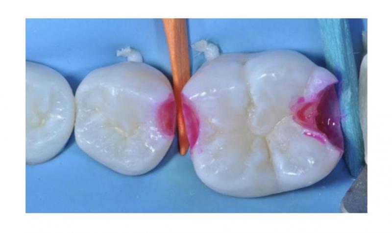 Кариес-маркёры и кариес-детекторы