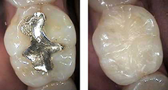 Керамические вкладки