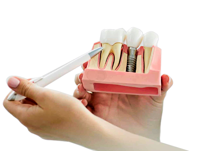 Имплантация